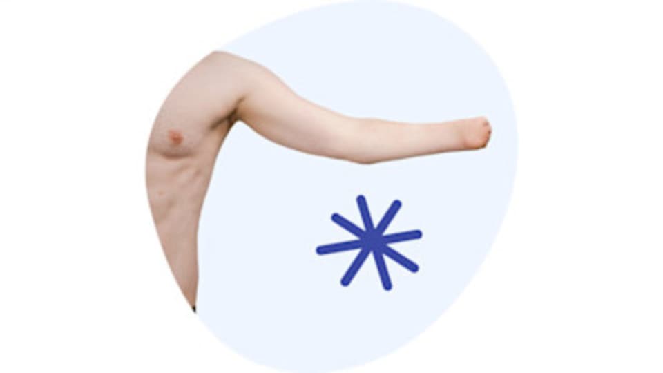 Mann mit Armstumpf Mann mit Armstumpf