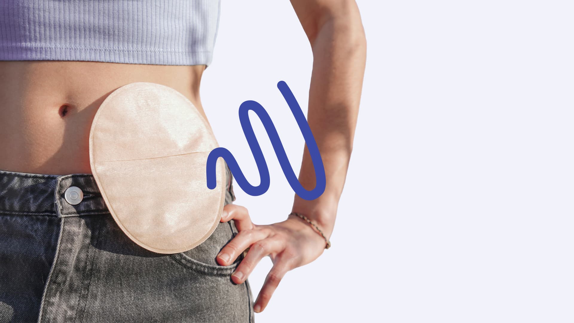 Stoma_hero Stoma_hero